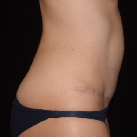 After image 3 Case #107896 - Abdominoplasty with Muscle Plication/Hernia Repair