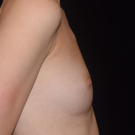Before image 6 Case #107901 - Underarm Endoscopic Breast Augmentation