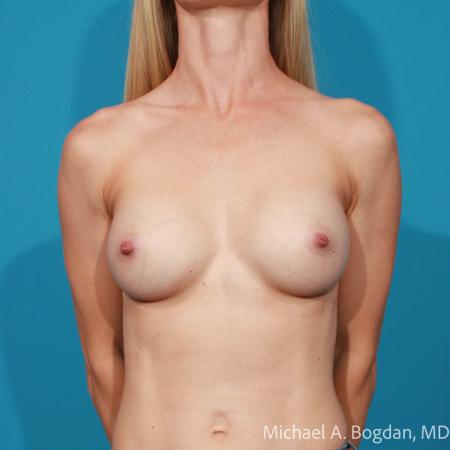 After image 1 Case #108306 - Breast Augmentation