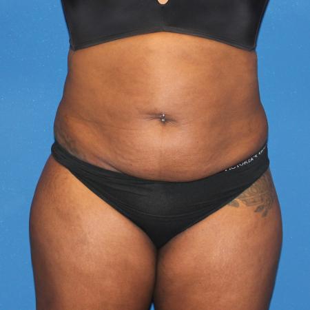 Before image 1 Case #107521 - Mommy Makeover