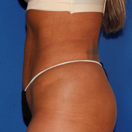 After image 3 Case #107826 - Liposuction Abdomen/Flanks with Abdominal Etching
