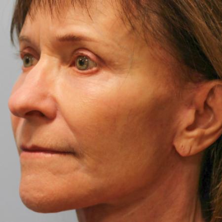 After image 2 Case #108286 - Facelift & Blepharoplasty