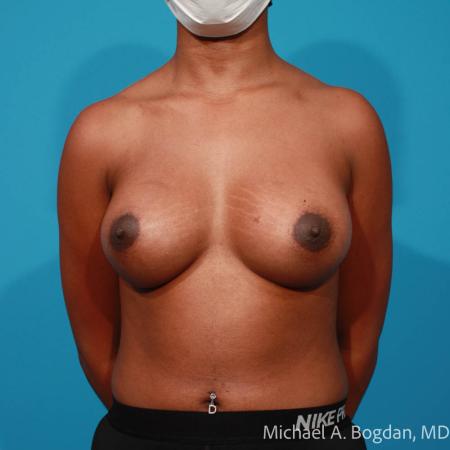 After image 1 Case #108351 - Breast Augmentation