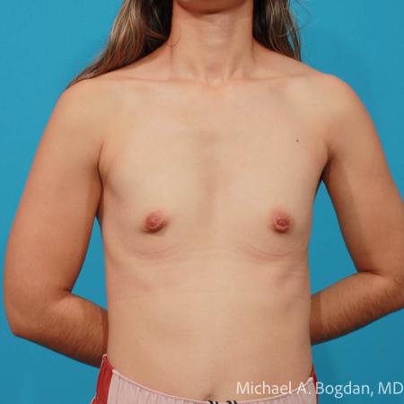 Before image 1 Case #108441 - Breast Augmentation