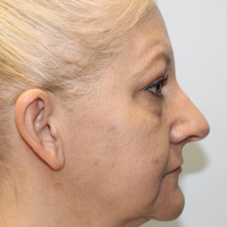 Before image 3 Case #108211 - Blepharoplasty