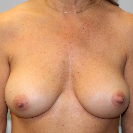 After image 1 Case #107941 - Breast Revision