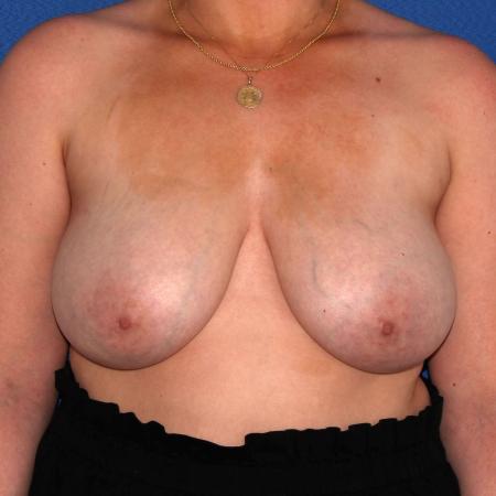 Before image 1 Case #108021 - Breast Lift