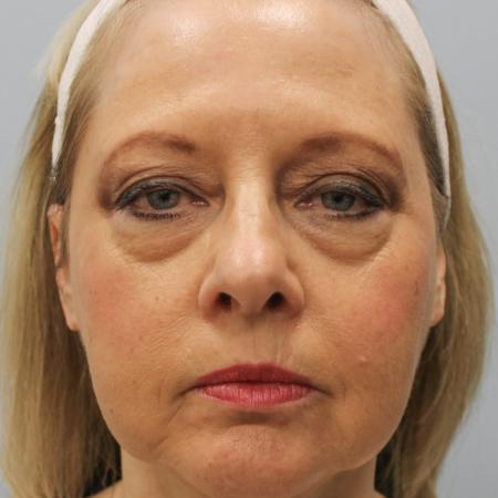 Before image 1 Case #108151 - Facelift & Blepharoplasty