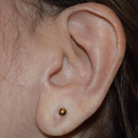 After image 2 Case #107916 - Earlobe Repair + Piercing