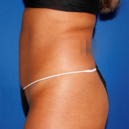 Before image 3 Case #107826 - Liposuction Abdomen/Flanks with Abdominal Etching