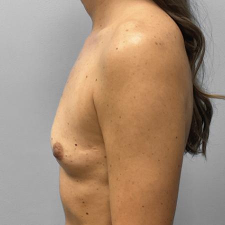 Before image 3 Case #108126 - Breast Augmentation