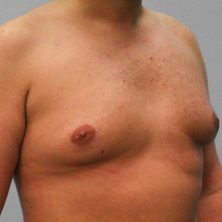 Before image 2 Case #107721 - Gynecomastia Sugery