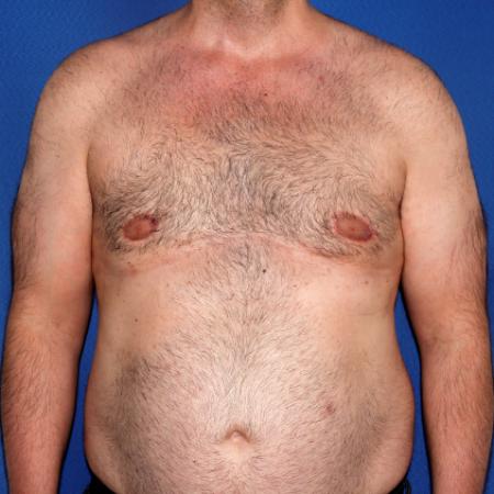 After image 1 Case #108916 - Gynecomastia Correction