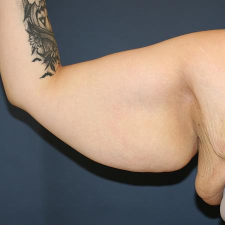 Before image 1 Case #108411 - Brachioplasty (Arm Lift)