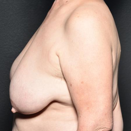 Before Case #108891 - Breast Reduction