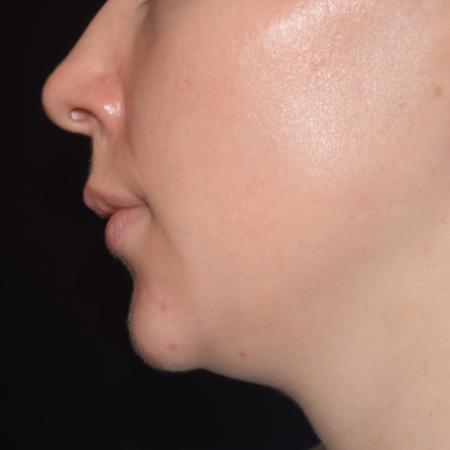 Before image 3 Case #108756 - Restylane Kysse Lip Enhancement