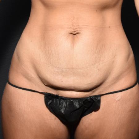 Before Case #108896 - Abdominoplasty (Tummy Tuck)