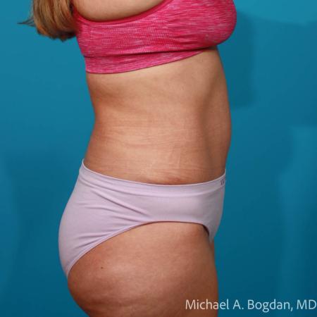 After image 3 Case #108651 - Abdominoplasty