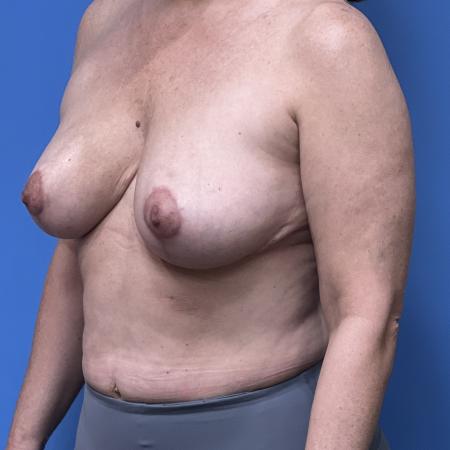 After image 2 Case #108871 - 47 year old  -  Bilateral Breast Reduction