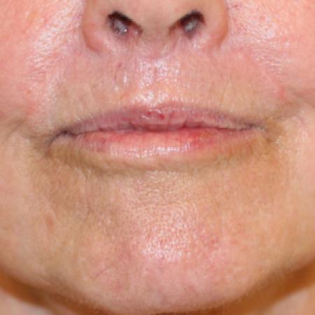 After image 1 Case #108821 - Upper Lip Lift + Corner Lip Lift