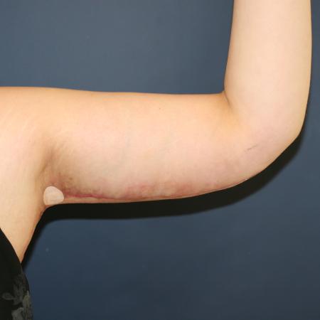 After image 2 Case #108411 - Brachioplasty (Arm Lift)