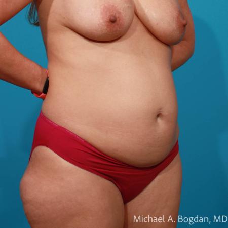 Before image 2 Case #108651 - Abdominoplasty