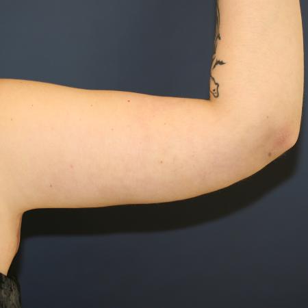 After image 3 Case #108411 - Brachioplasty (Arm Lift)