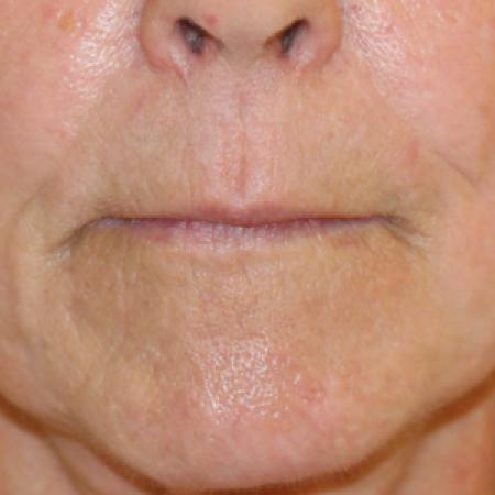 Before image 1 Case #108821 - Upper Lip Lift + Corner Lip Lift