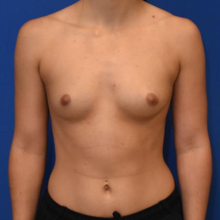 Before image 1 Case #108741 - Breast Augmentation
