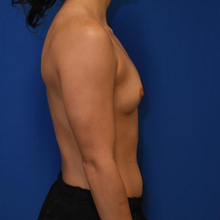 Before image 3 Case #108741 - Breast Augmentation