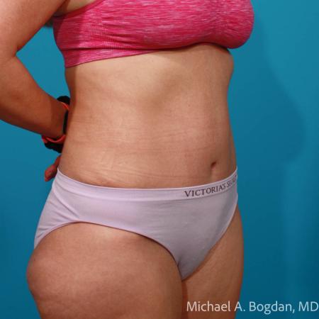 After image 2 Case #108651 - Abdominoplasty