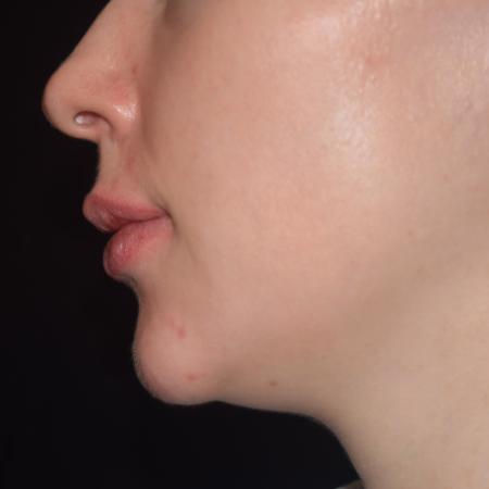 After image 3 Case #108756 - Restylane Kysse Lip Enhancement