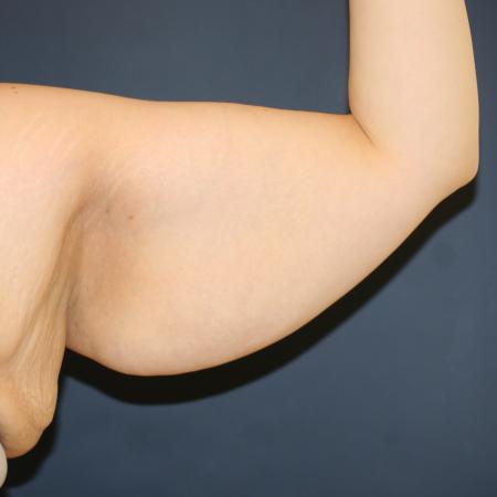 Before image 2 Case #108411 - Brachioplasty (Arm Lift)