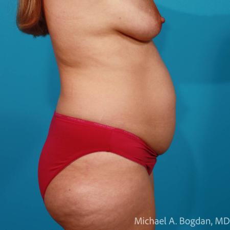 Before image 3 Case #108651 - Abdominoplasty