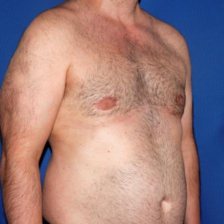 After image 2 Case #108916 - Gynecomastia Correction