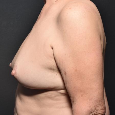 After Case #108891 - Breast Reduction