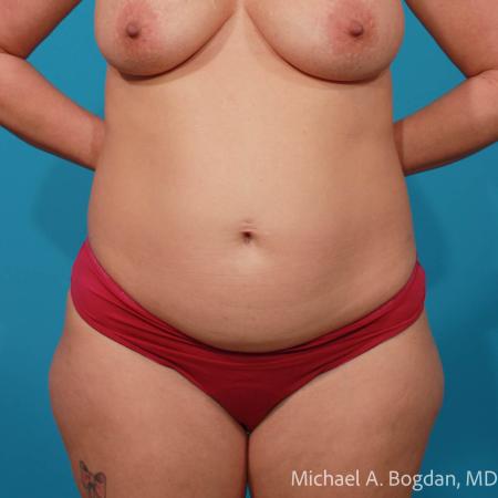 Before image 1 Case #108651 - Abdominoplasty