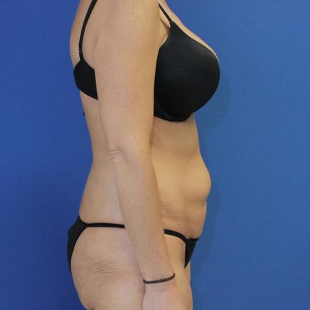 Before image 3 Case #108746 - Tummy Tuck