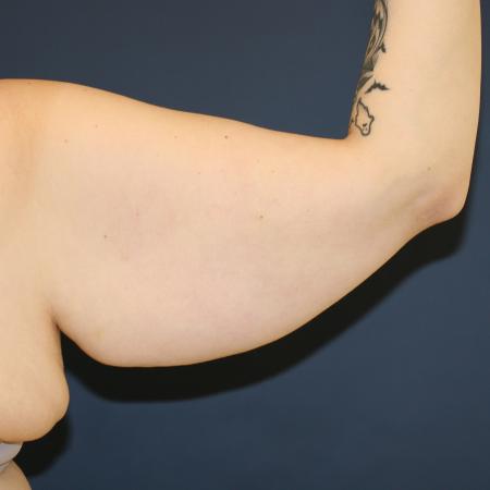 Before image 3 Case #108411 - Brachioplasty (Arm Lift)