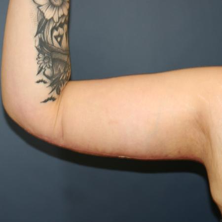 After image 1 Case #108411 - Brachioplasty (Arm Lift)