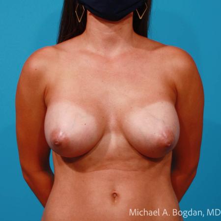 After image 1 Case #108631 - Breast Augmentation