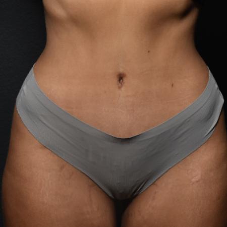 After Case #108896 - Abdominoplasty (Tummy Tuck)