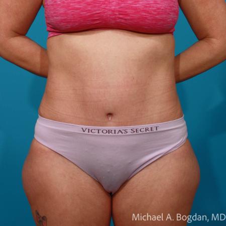 After image 1 Case #108651 - Abdominoplasty