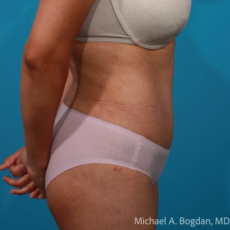 After image 3 Case #109036 - Abdominoplasty