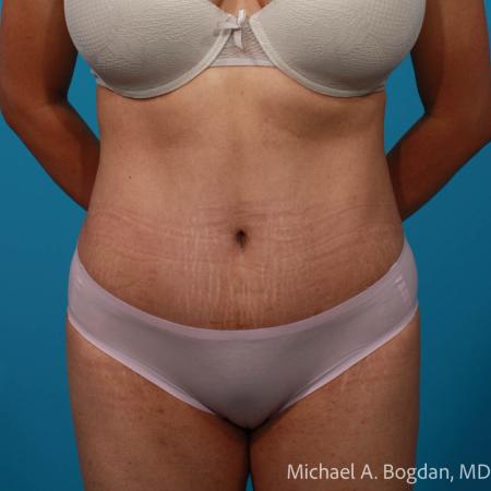 After image 1 Case #109036 - Abdominoplasty