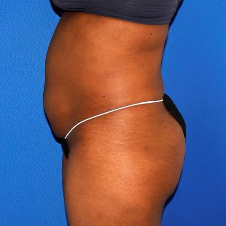 Before image 3 Case #109146 - Liposuction and Fat Transfer to Buttock