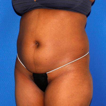 Before image 2 Case #109146 - Liposuction and Fat Transfer to Buttock
