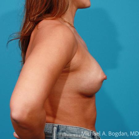 After image 3 Case #109031 - Breast Augmentation