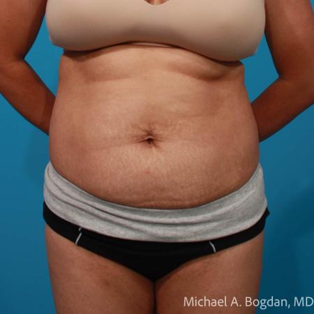 Before image 1 Case #109036 - Abdominoplasty