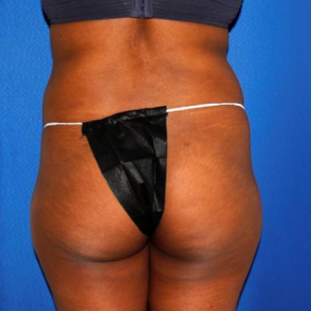 Before image 4 Case #109146 - Liposuction and Fat Transfer to Buttock
